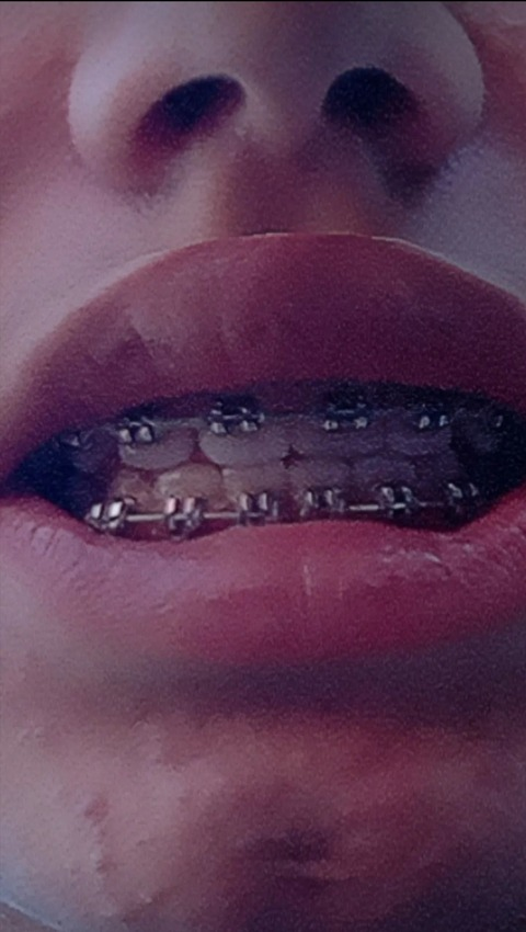 bracesfetish onlyfans leaked picture 1